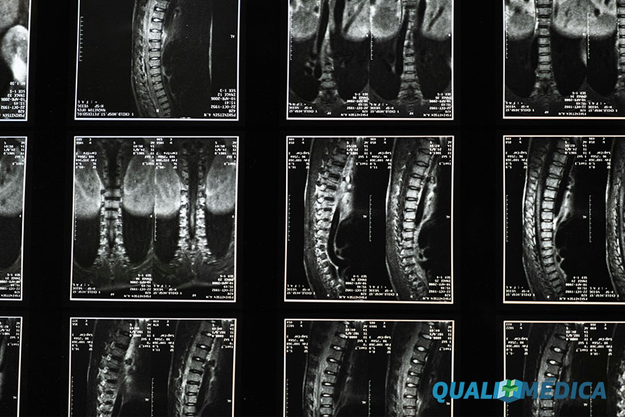 Ressonância magnética da coluna